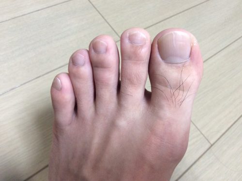 家庭用脱毛器ケノンを男の足の指毛に使ってみました このブログ記事は随時更新します こぐむし